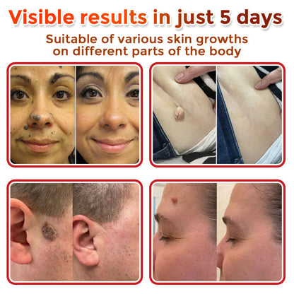 GFOUK® MicroNeedle Botanic Skin Tag Removal Patch