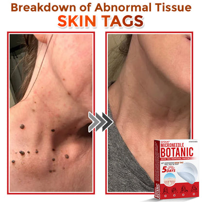 GFOUK® MicroNeedle Botanic Skin Tag Removal Patch