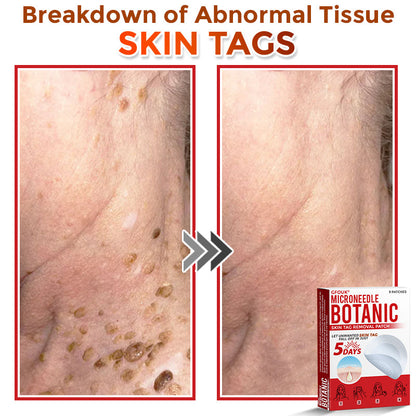 GFOUK® MicroNeedle Botanic Skin Tag Removal Patch