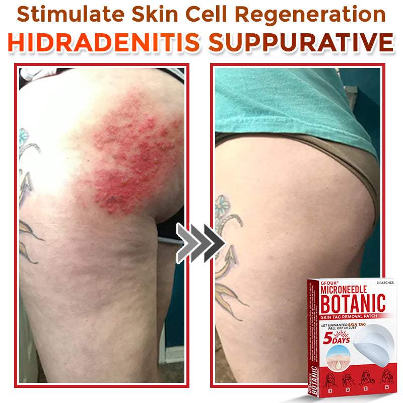 GFOUK® MicroNeedle Botanic Skin Tag Removal Patch