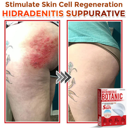 GFOUK® MicroNeedle Botanic Skin Tag Removal Patch