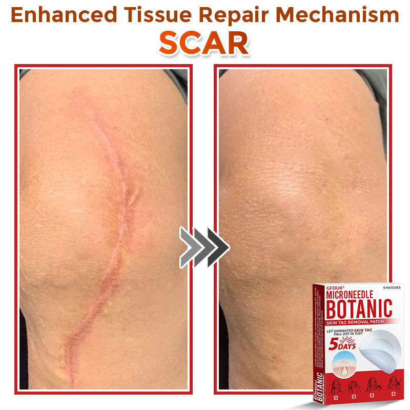 GFOUK® MicroNeedle Botanic Skin Tag Removal Patch